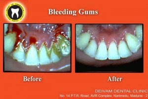 Bleeding Gums Treatment Madurai