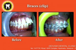 metal-dental-braces