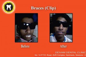 dental-brace-treatments