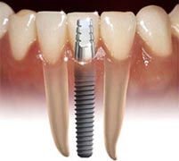 dental implant image