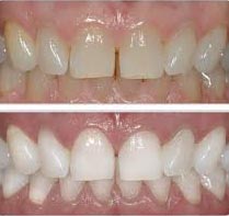 tooth-bleaching